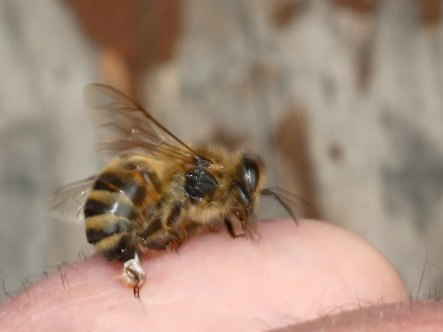 Honey bee stinging a human finger with the barbed stinger left in the skin