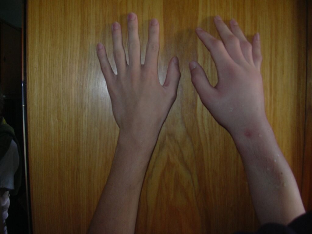 Bee sting site showing signs of infection two days after the sting
