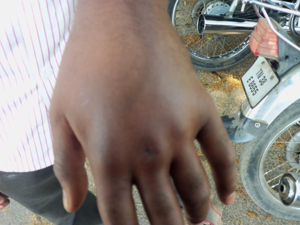 Swollen hand showing a large local reaction after a honey bee sting