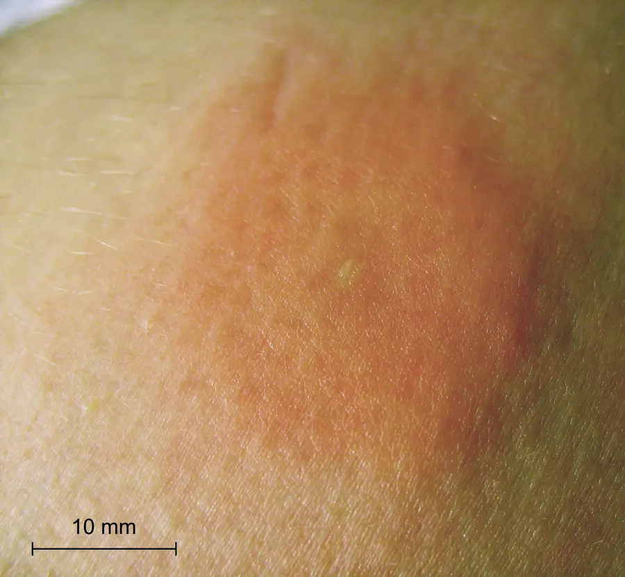 Close-up of a red, swollen patch of skin on an arm one day after a honey bee sting, with a 10 mm scale bar